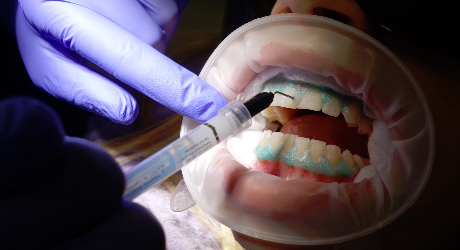 cleaning intense advanced teeth whitening