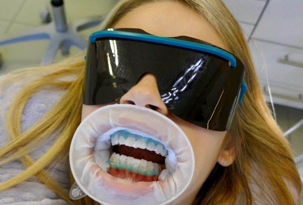 Teeth whitening patient at Archer Dental with protective eye wear, mouth guard, gingival barrier