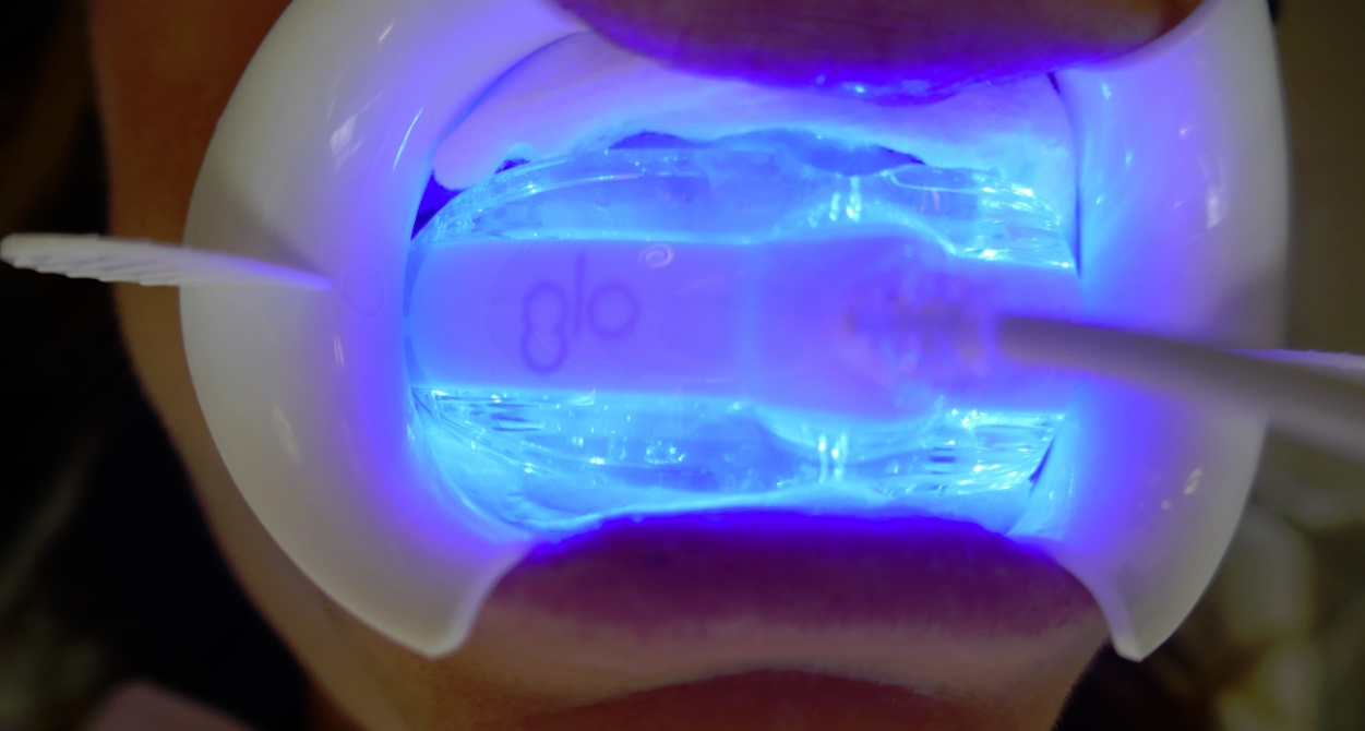 GLO Science at work in Dr Archer's mouth - Archer Dental teeth Whitening test