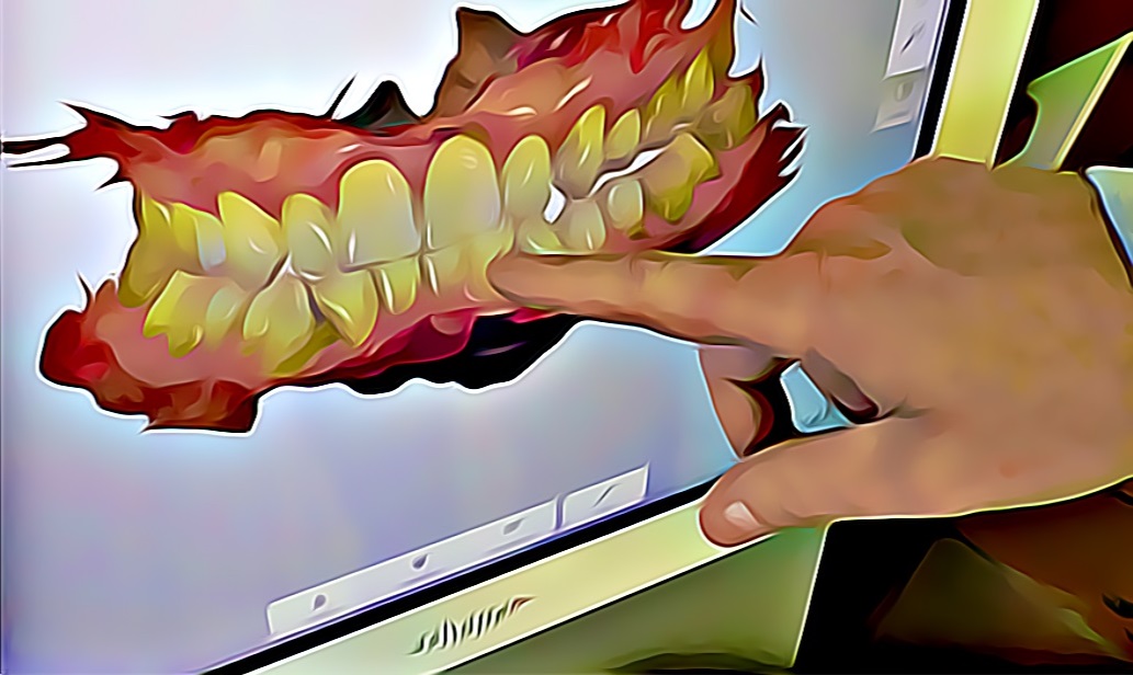 digital scan showing teeth straightening orthodontist