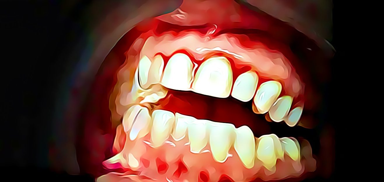 bleeding gums, blood drips from open mouth