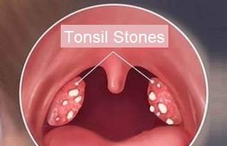 Tonsil Stones cause halitosis