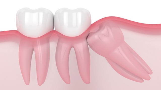 Impacted wisdom tooth - why wisdom teeth are removed
