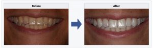 teeth whitening before and after pictures