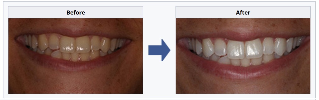 teeth whitening before and after pictures 