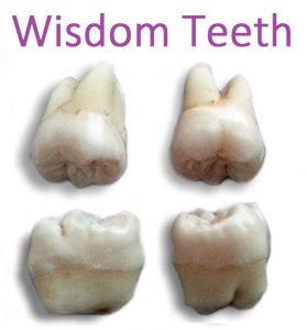 Wisdom Teeth, what they look like