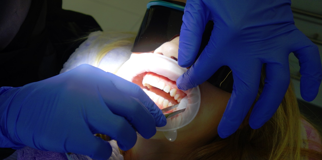 Teeth whotening peroxide optical whitening system