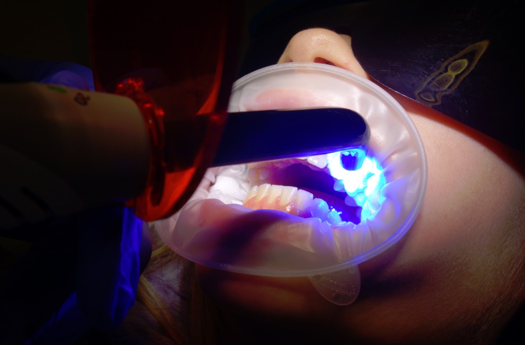 peroxide laser white teeth whitening in Toronto at Archer Dental 