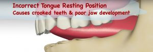 myobrace graphic showing incorrect tounge position on teeth