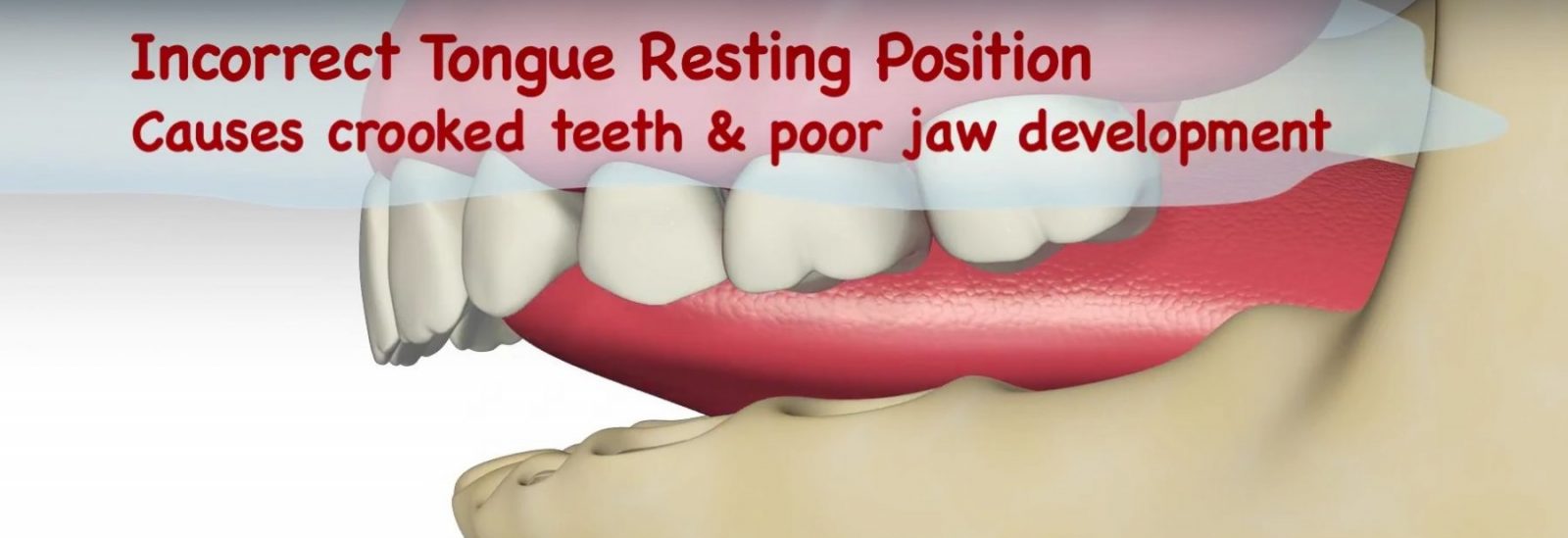 myobrace graphic showing incorrect tounge position on teeth 