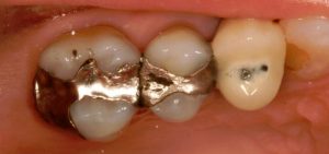 old mercury and silver filings in teeth hide cavities