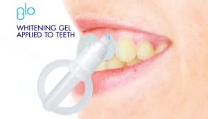 dental staff applies GLO Science peroxide paste to teeth whitening patient in office treatment