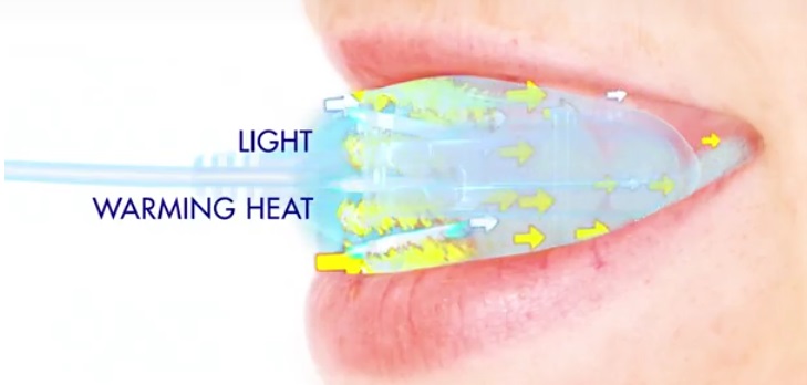 GLO science teeth whotening - heat and light on hydrogen peroxide