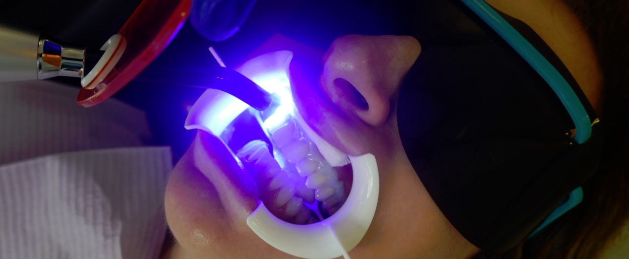 curing the gingival barrier before teeth whitening at Archer Dental