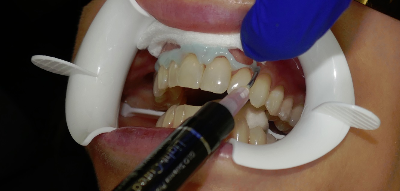 applying gingival barrier to teeth whitening patient