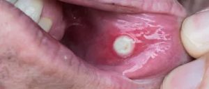 cures for canker sores in Toronto