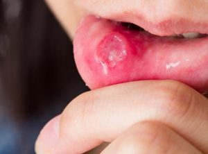 girl with canker sore