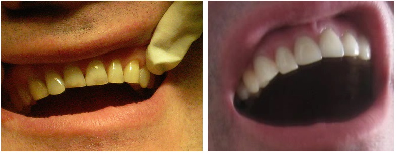 veneers, front teeth, smile, before & after