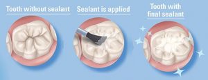 How dental sealants work to prevent tooth decay