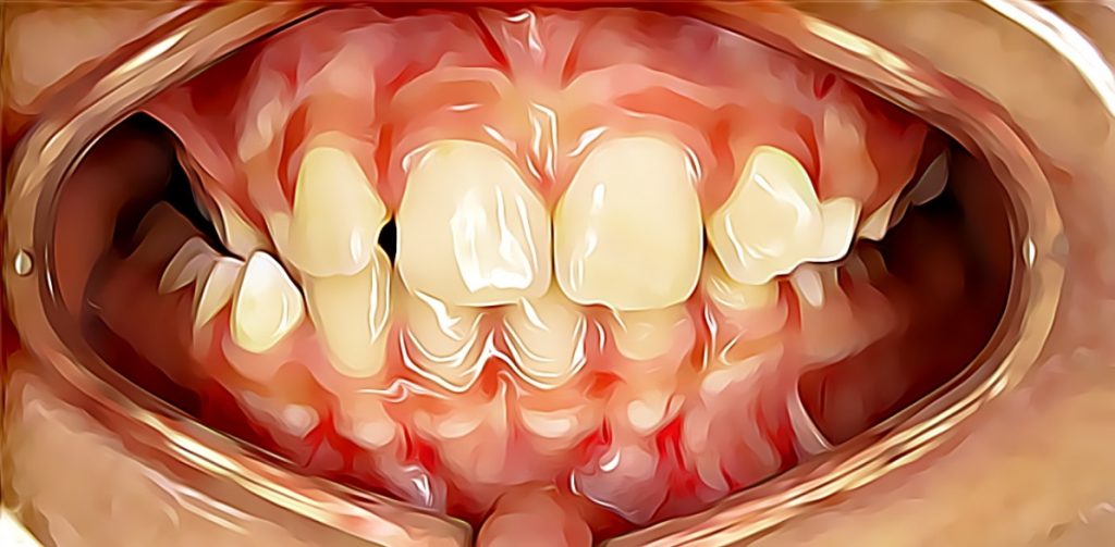 Crossbite dental condition before orthodontics