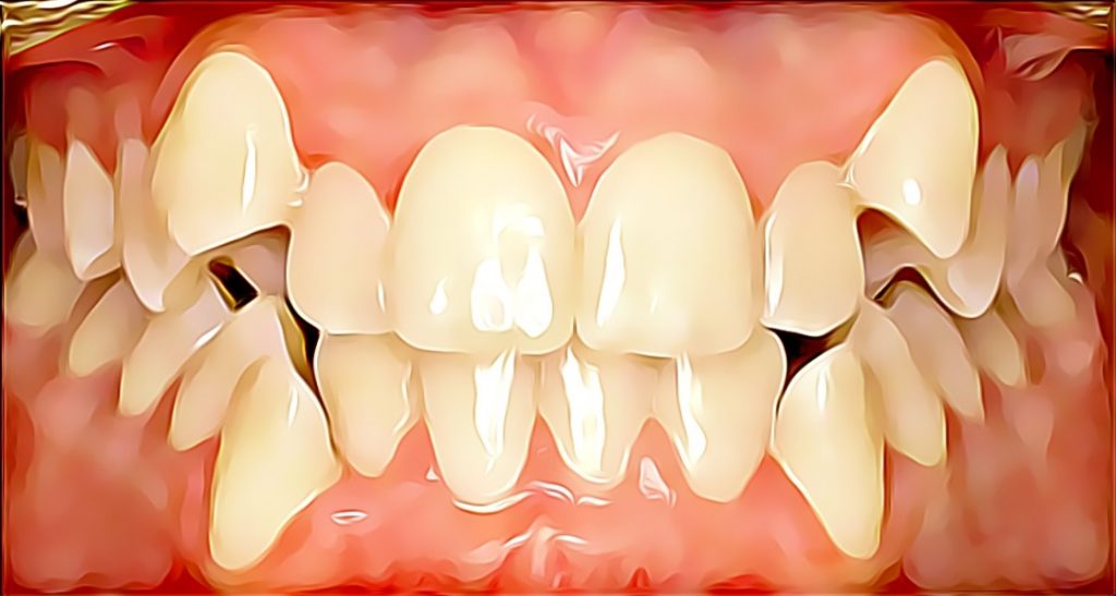 crowded teeth before brace, invisalign