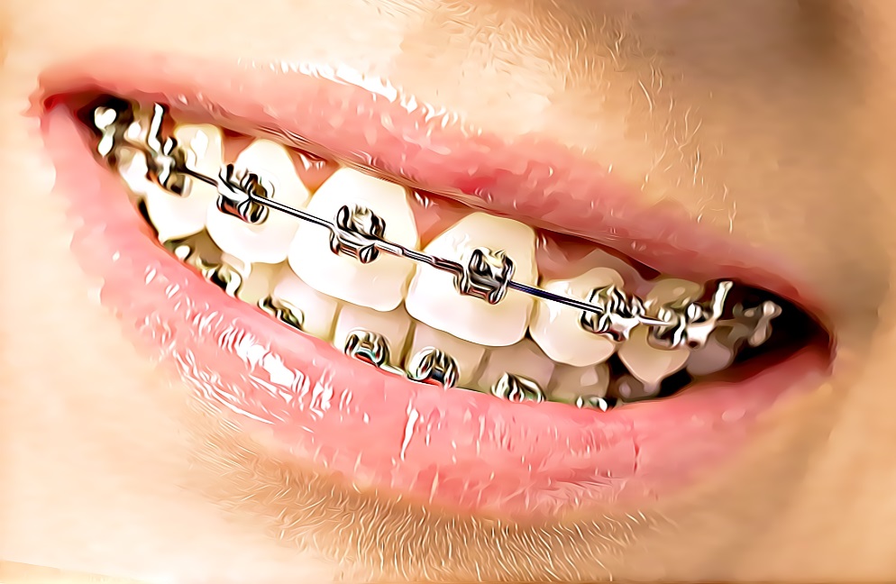 orthodontics, metal braces Toronto