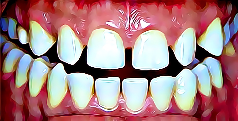 teethgaps before Invisalign, braces, orthodontic treatment