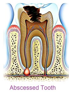 Abcessed Tooth