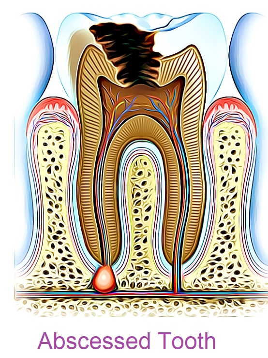 abcessed-tooth2.jpg