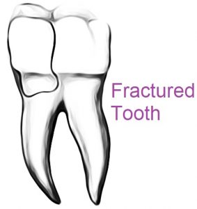 cracked tooth, fracture, toothache pain