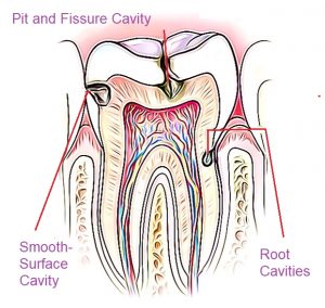 three different types of cavities