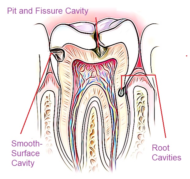 three different cavity types - 8 Items That Are Excellent For Taking Care Of Delicate Teeth