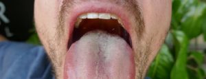 infected mouth, halitosis in adult male