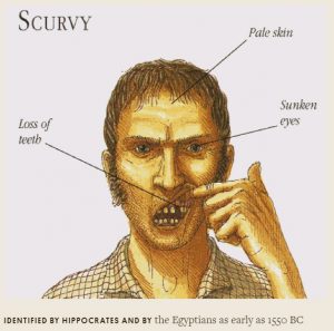 Scurvy is a Vitamin C deficiency
