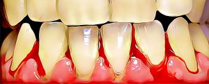 Bleeding gums, causes and treatments for bloody gums