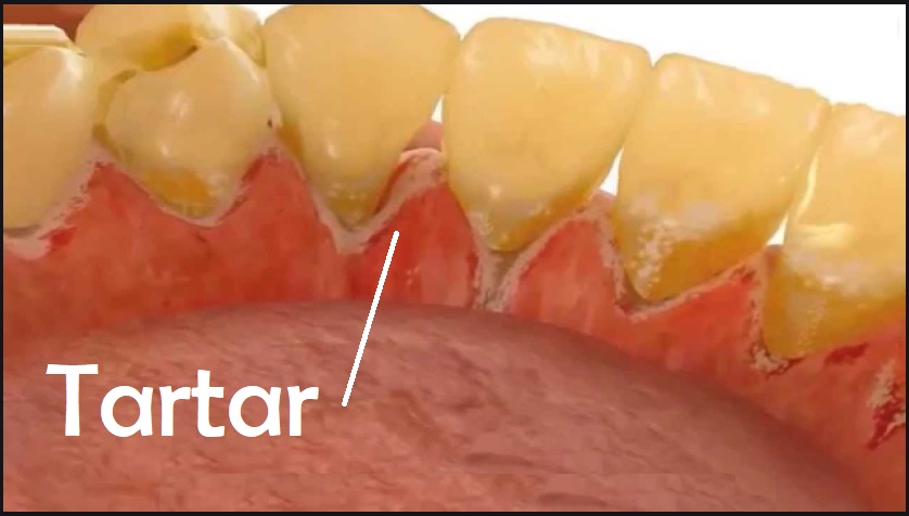 teeth cleaning graphic Toronto tartar