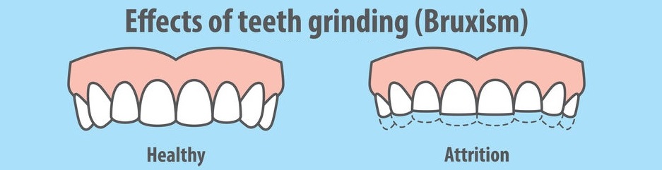 Effects of teeth grinding Bruxism