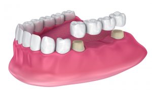 dental bridge