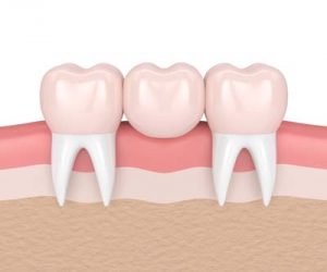3 tooth bridge