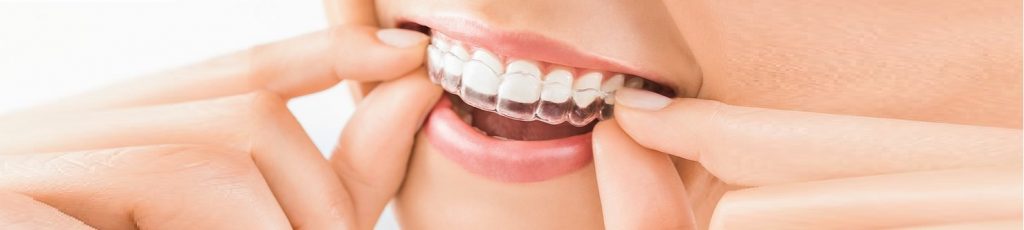 Invisalign clear aligners in Toronto