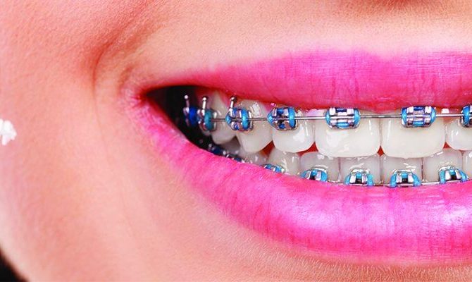 metal braces at Archer Dental