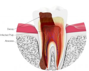 Root cana required for decayed tooth with infection