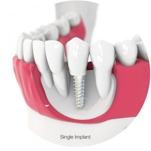 single dental implant - canine