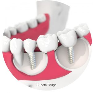 3 tooth dental implant