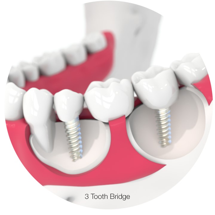 3 tooth dental implant 