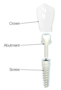 dental implant with screw crown abutment