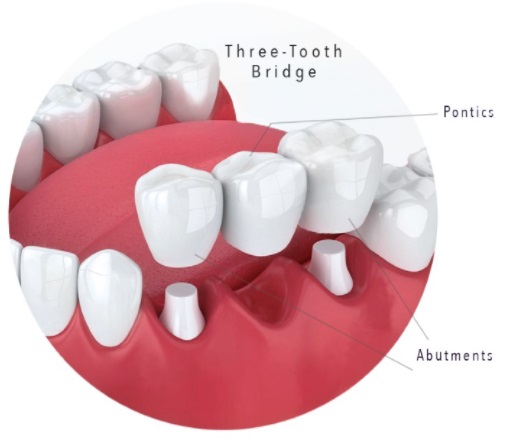 3-tooth-bridge-dental-solution