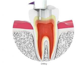 drilling out a root canal