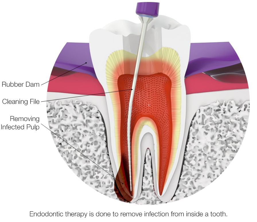 Root canal therapy, endodontic tool cleaning the root of the tooth