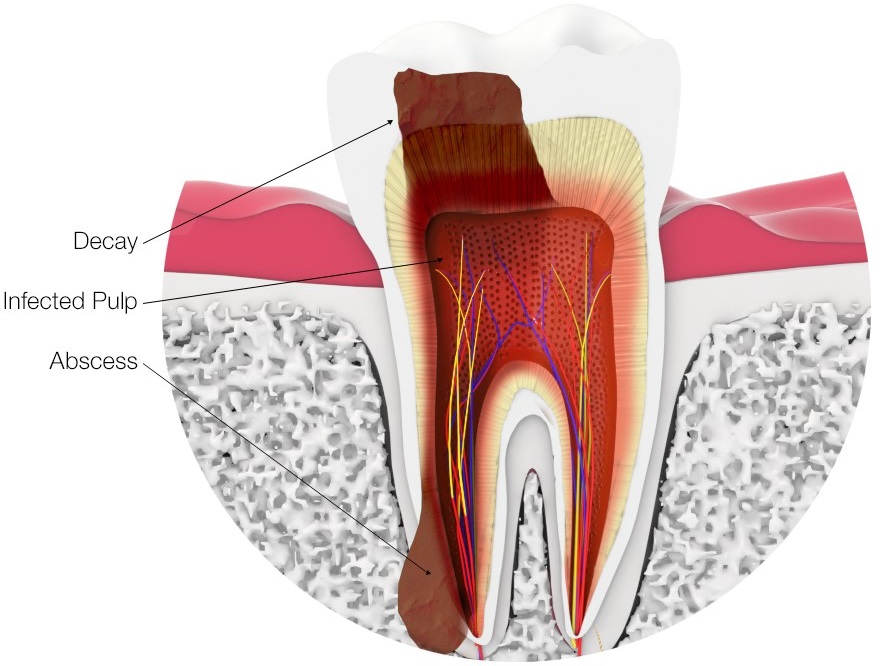 decayed tooth requiring root canal